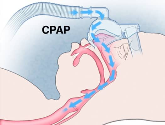 CPAP ทำงานอย่างไร