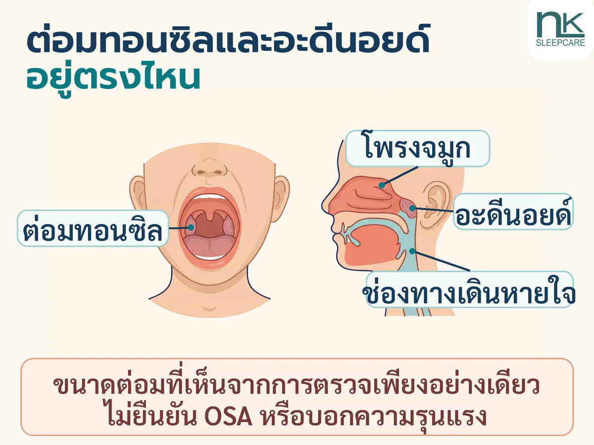 The image shows the location of the tonsils on the sides of the throat and the adenoids behind the nasal cavity, which may cause narrowing of the airway. However, tonsil size alone does not confirm OSA or indicate its severity.