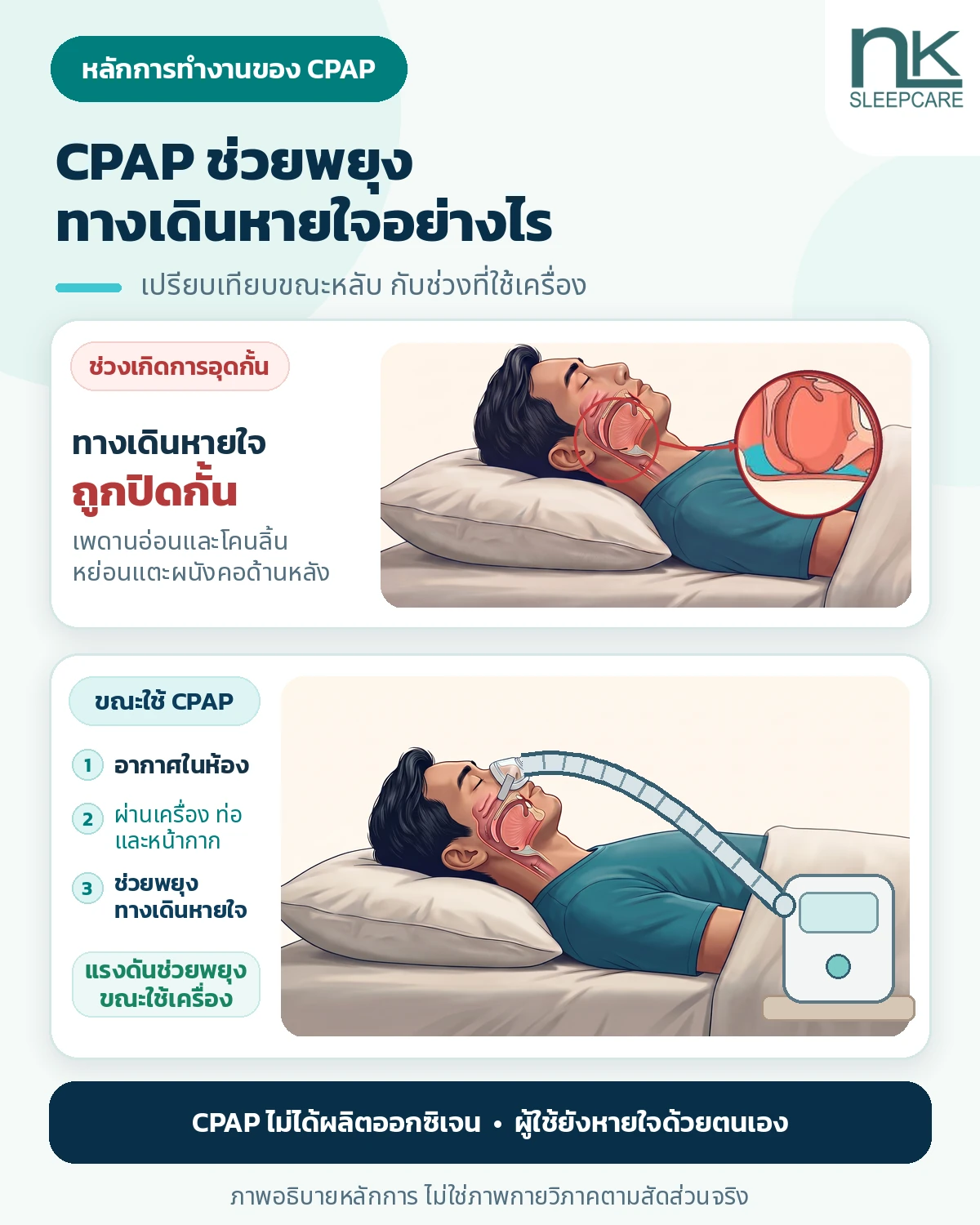 ภาพเปรียบเทียบคนคนเดียวกันด้วยภาพตัดขวางช่องคอ ขณะเกิดการอุดกั้นจากเพดานอ่อนและโคนลิ้นกับช่วงใช้ CPAP พร้อมวงขยายจุดอุดกั้นและการไหลของอากาศผ่านเครื่อง ท่อ และหน้ากาก